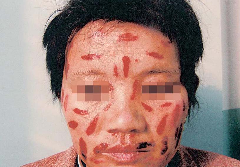 8.人工皮炎